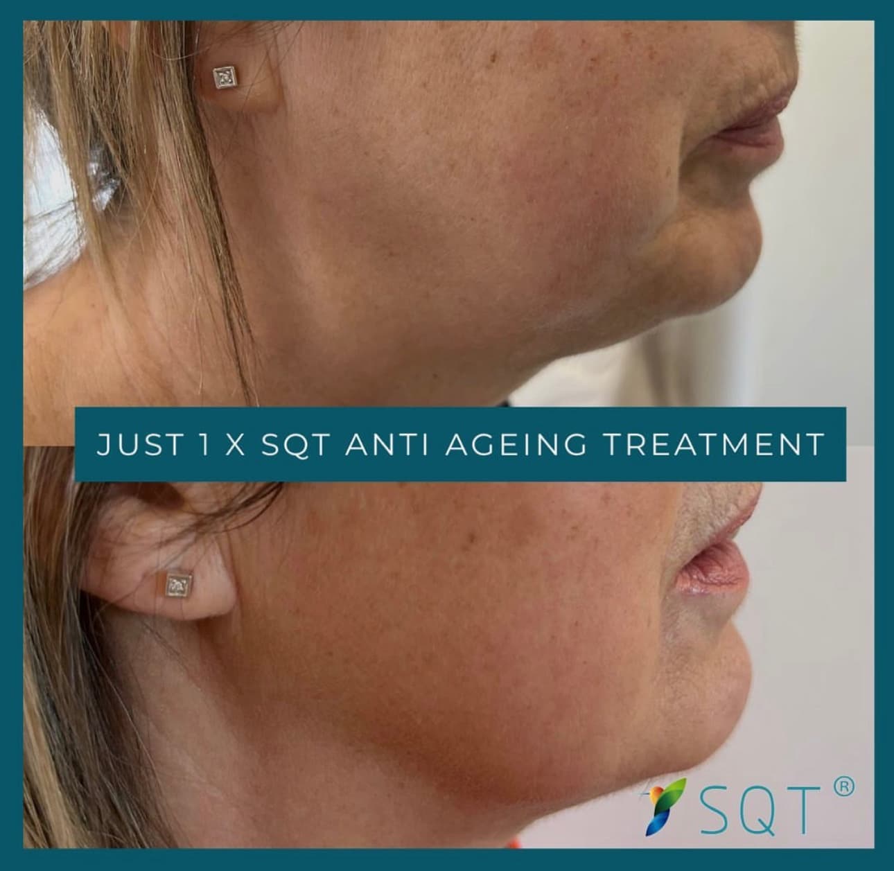 SQT Bio Microneedling jowls, Norwich , Norfolk