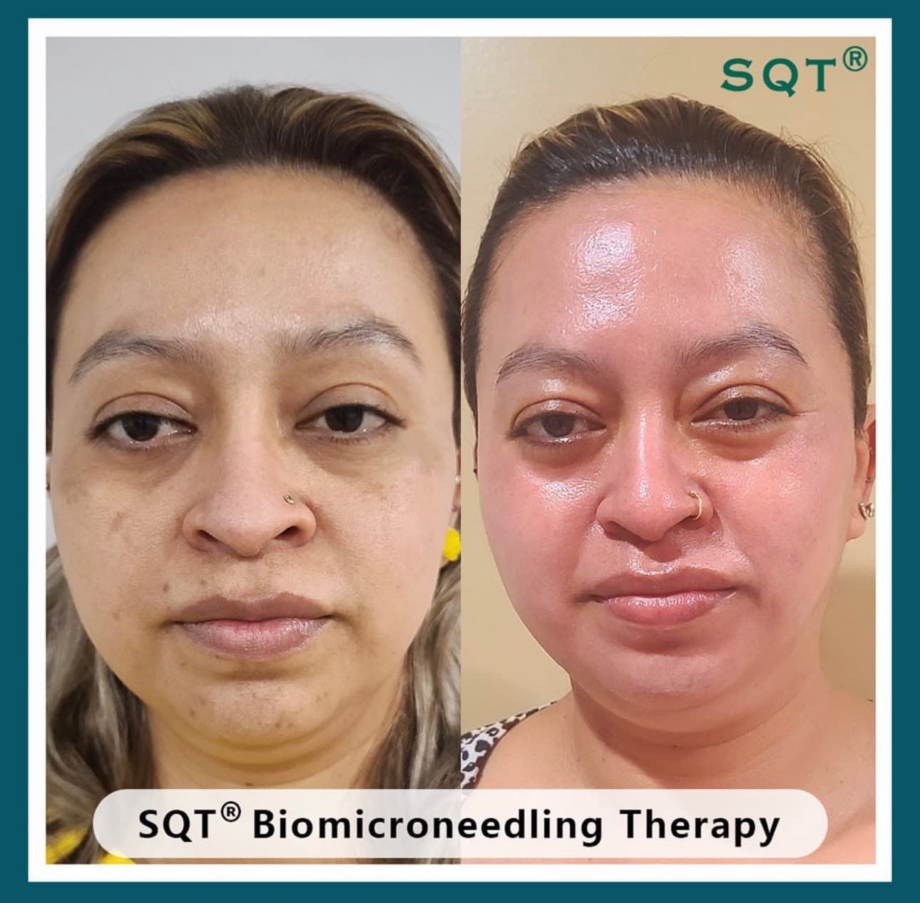 SQT Bio Microneedling hyperpigmentation melasma, Norwich , Norfolk