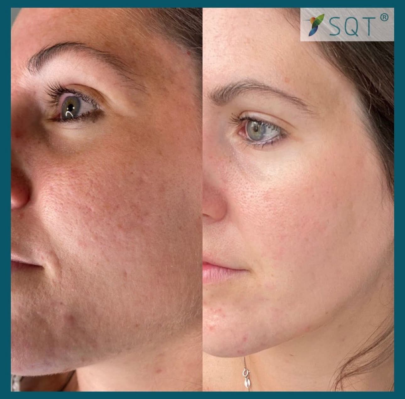 SQT Bio Microneedling dull skin pores acne scarring, Norwich , Norfolk