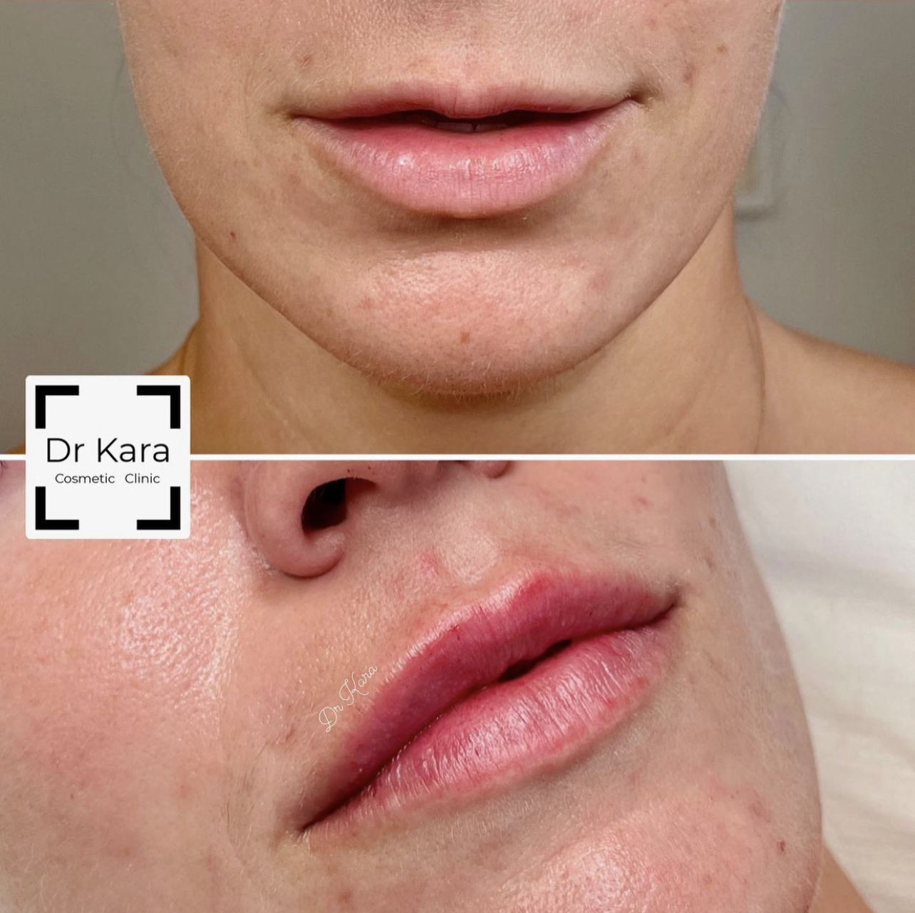 Lip dermal filler result by Dr Kara Cosmetic Clinic , Norwich , Norfolk