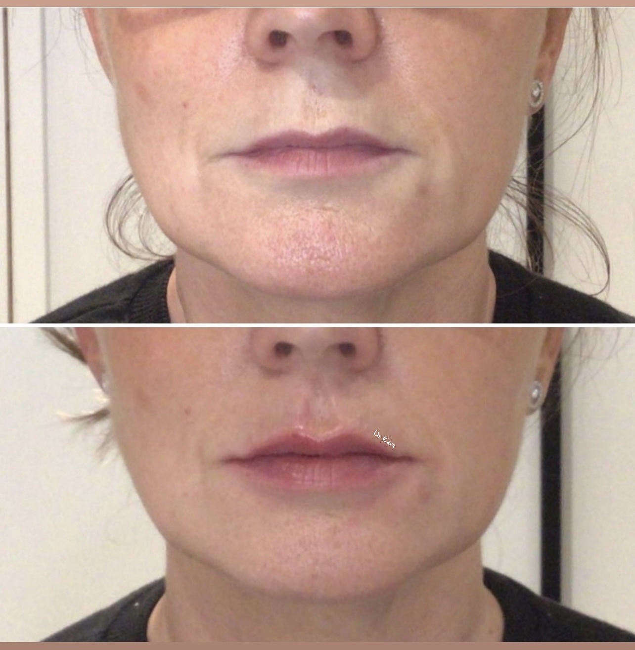 Lip filler result by Dr Kara Cosmetic Clinic , Norwich , Norfolk , UK