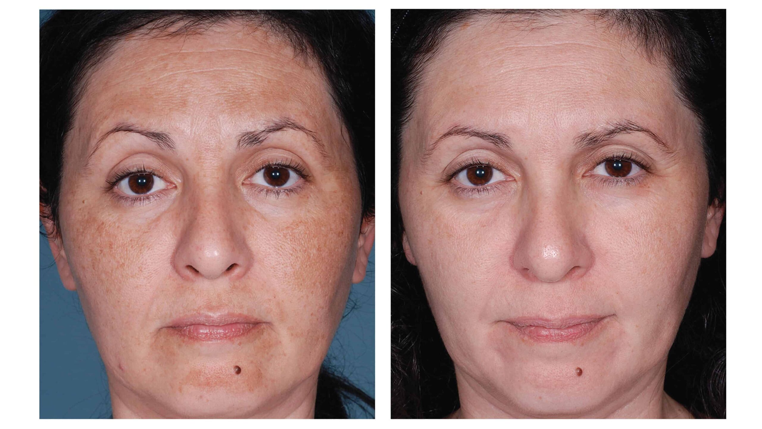 US Nu Derm Tretinoin Before After 1 e1592389762598 scaled