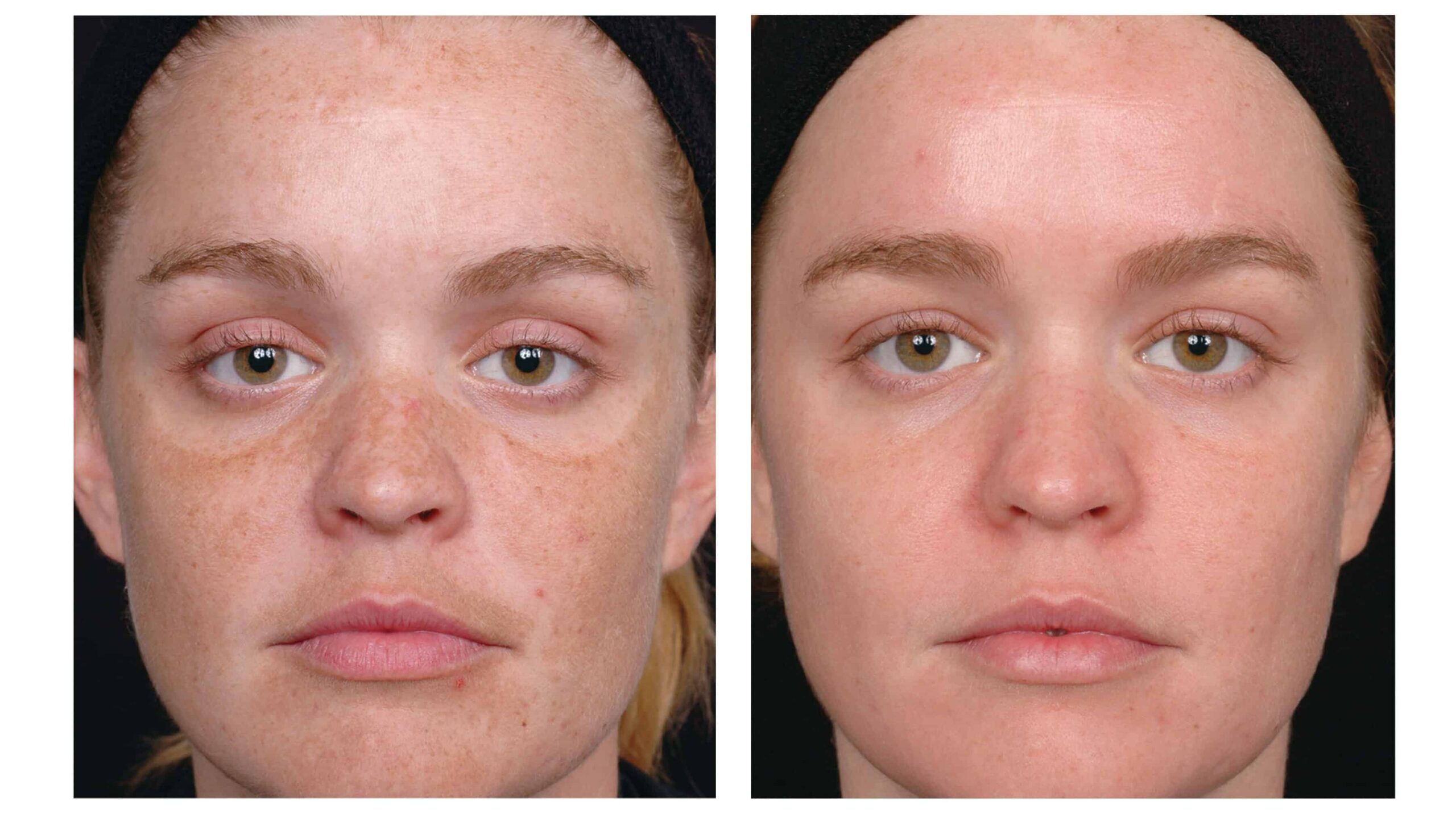 US Nu Derm Tretinoin Before After 4 e1592389235506 scaled