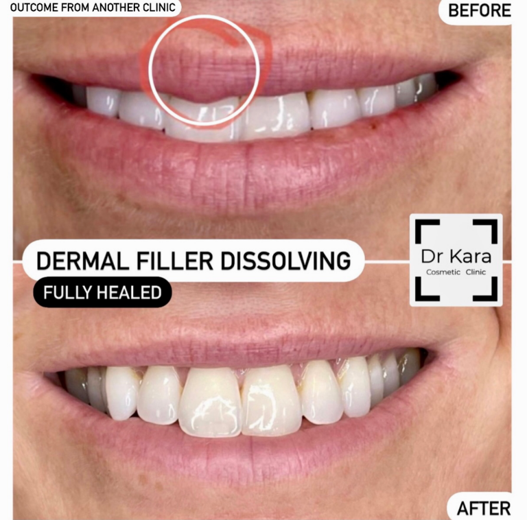 Treatments 5 Before and after close-up of lips showing dermal filler dissolving, fully healed