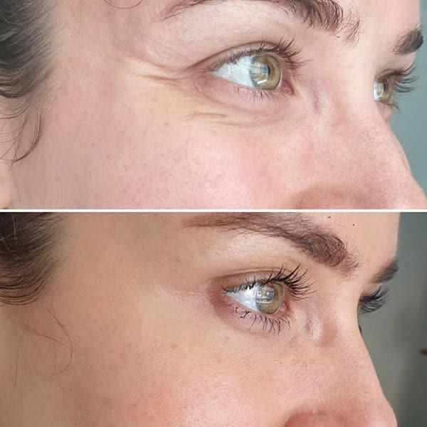 Botox treatment result by Dr Kara Cosmetic Clinic