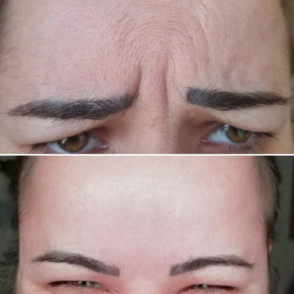 Botox treatment for frown lines by Dr Kara Cosmetic Clinic , Norwich , UK