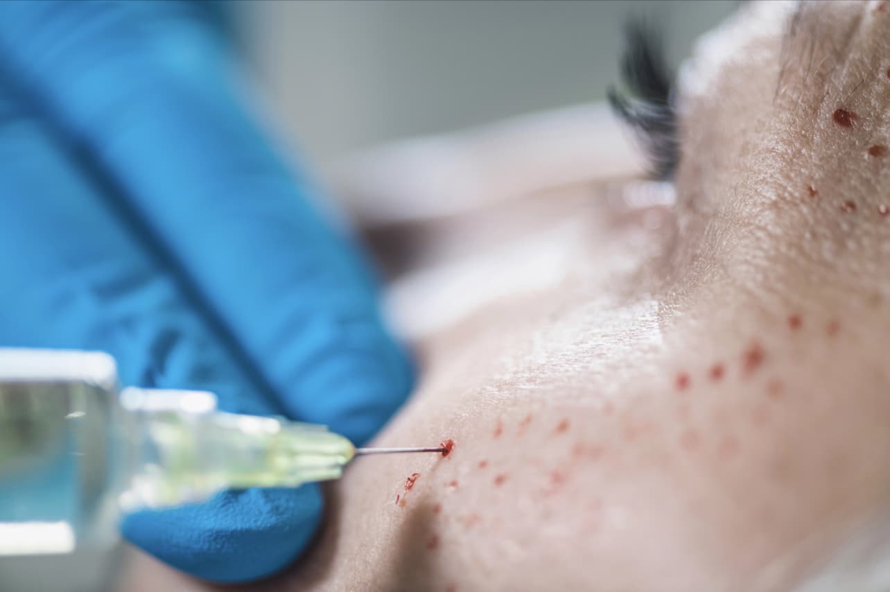 Platelet rich plasma face treatment