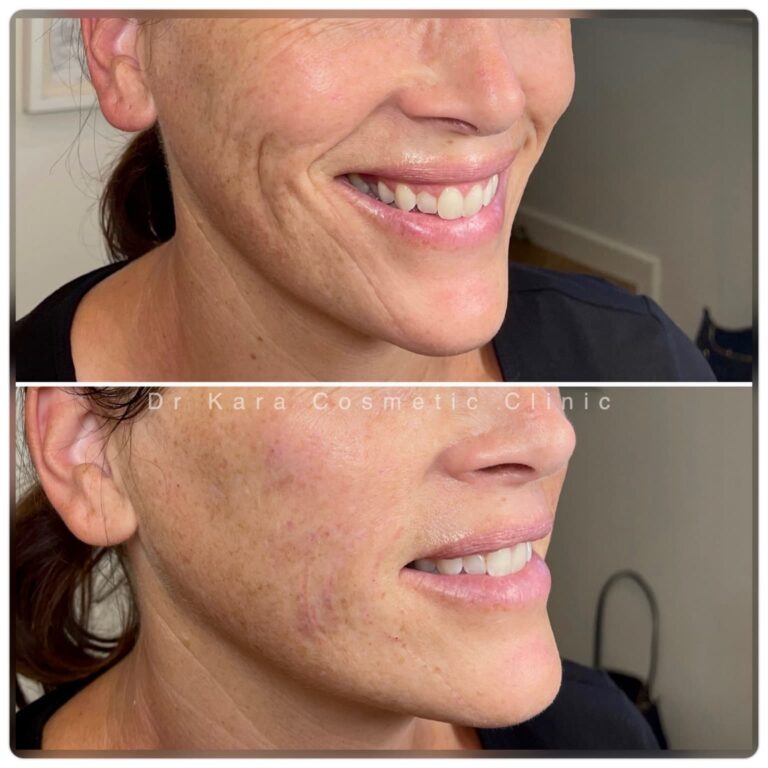Treatments 2 Smile lines dermal filler result photo from Dr Kara Cosmetic Clinic, Norwich