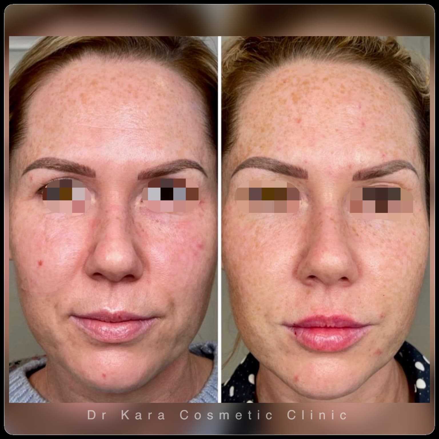 Skincare, dermal filler, lip filler and PRP facial results by Dr Kara Cosmetic Clinic, Norwich, Norfolk