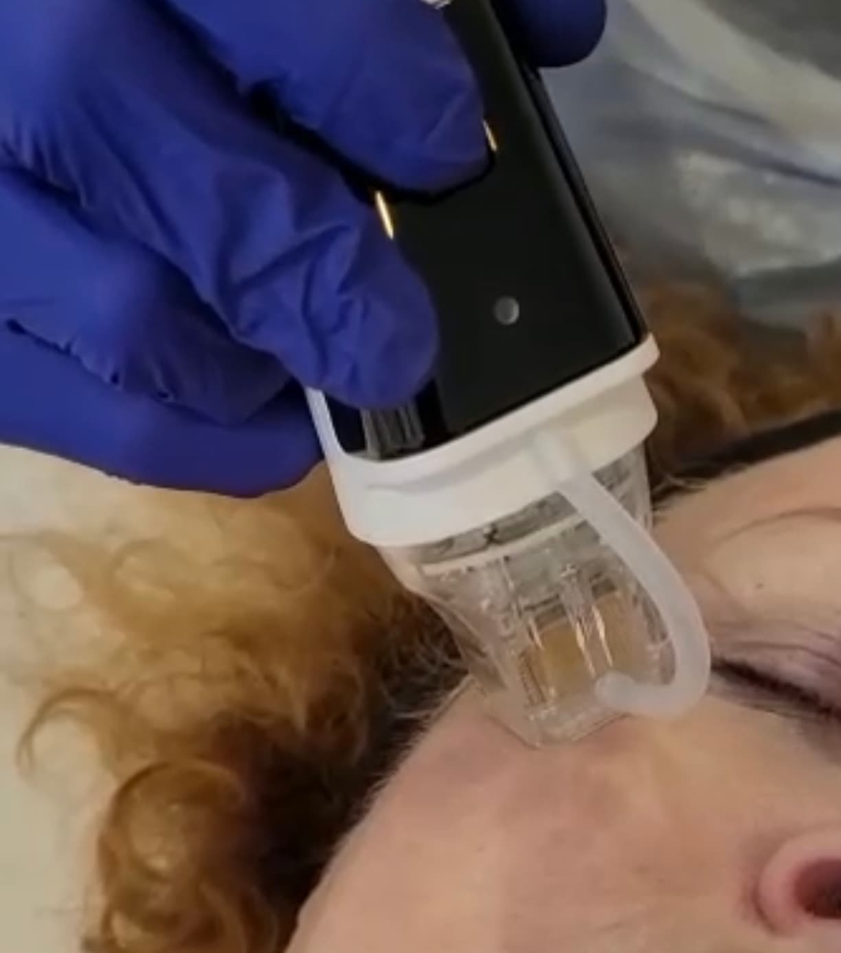 Radiofrequency Microneedling in Norwich, Norfolk, using PureDerma