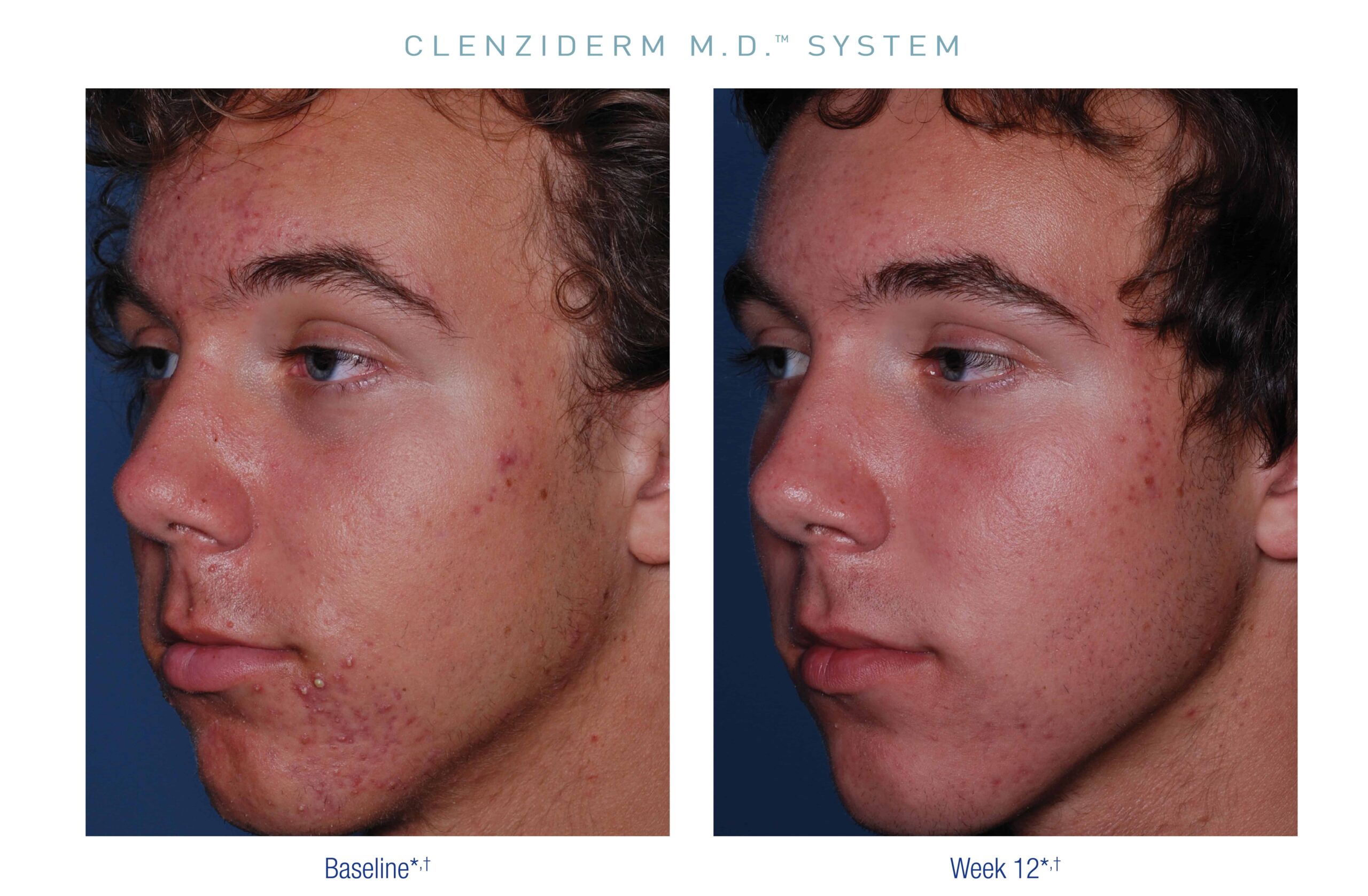 Obagi US Clenziderm Before After 3 e1594665399606 scaled