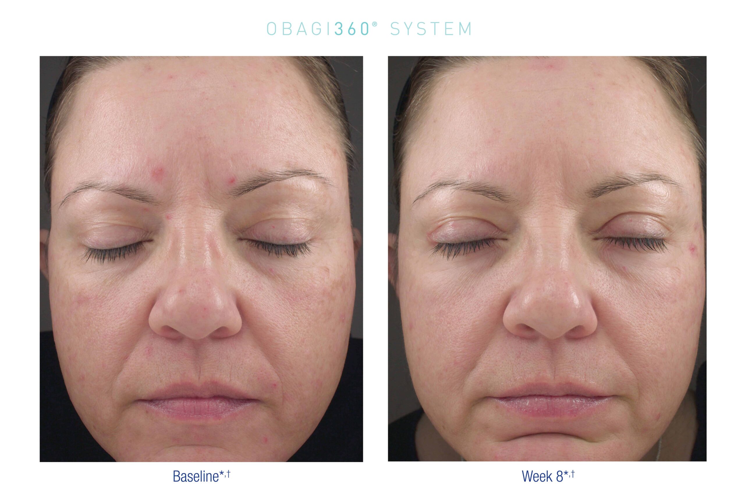 US OBAGI360 Before After 1 e1592226380457 scaled