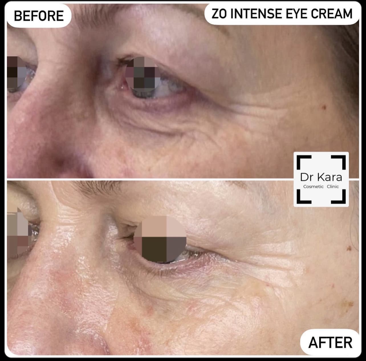 ZO Intense eye cream skincare result by Dr Kara Cosmetic Clinic , Norwich,Norfolk