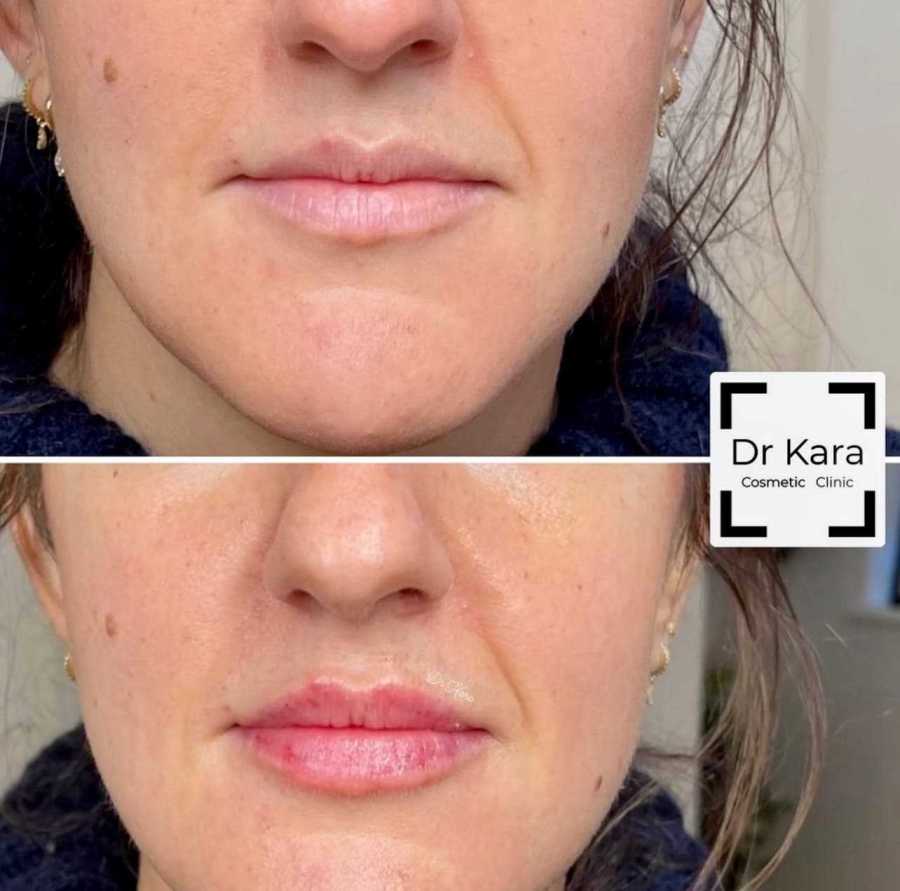 Dr Kara Cosmetic Clinic 11 Lip filler before and after result by Dr Kara Cosmetic Clinic in Norwich, Norfolk, UK