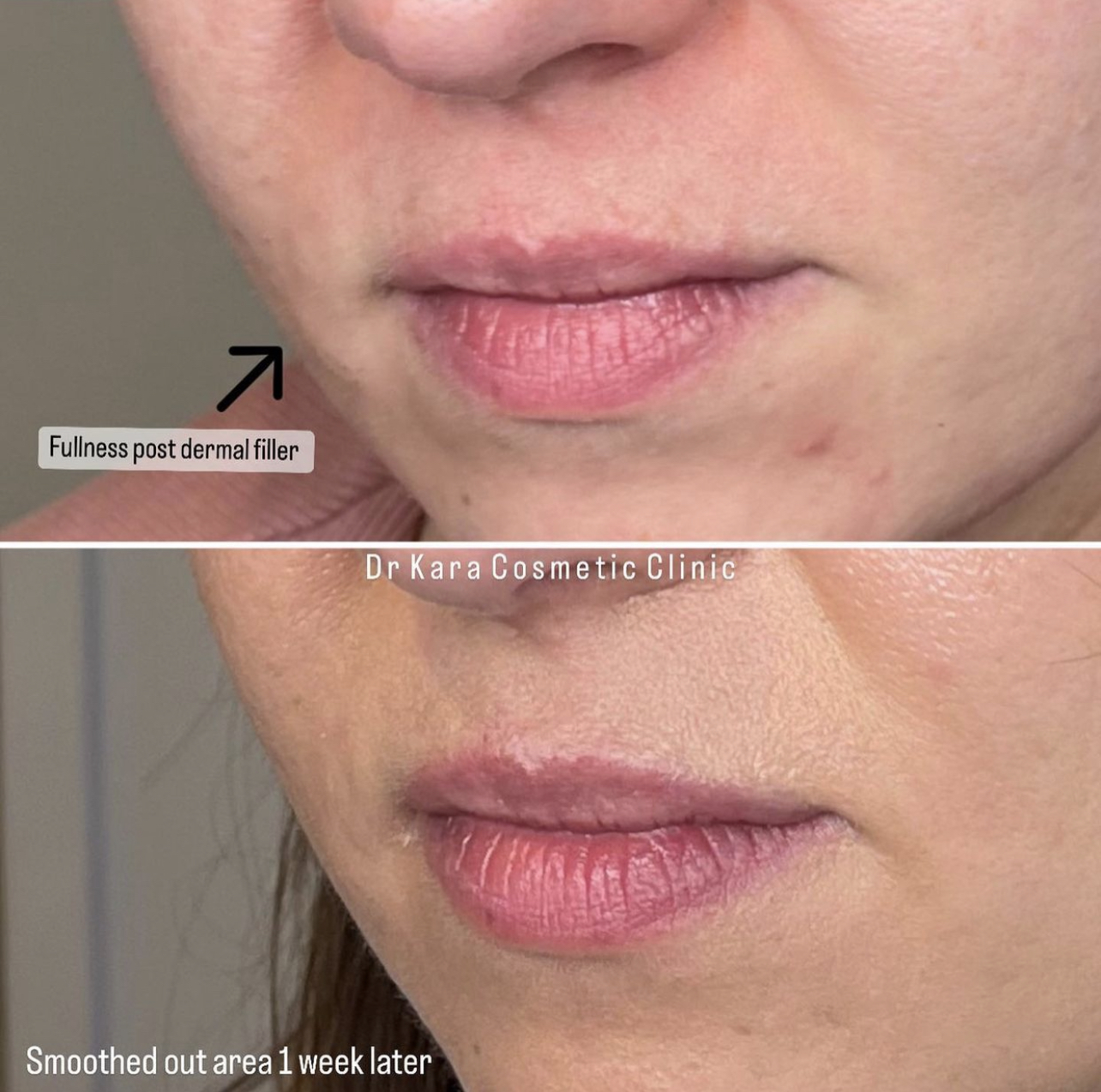 Topilase result by Dr Kara Cosmetic Clinic, Norwich,Norfolk