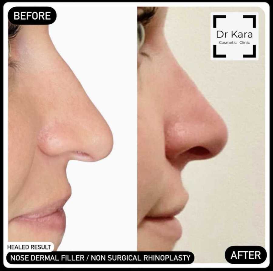 Dr Kara Cosmetic Clinic 14 Non surgical rhinoplasty / nose dermal filler by Dr Kara Cosmetic Clinic , Norwich , Norfolk
