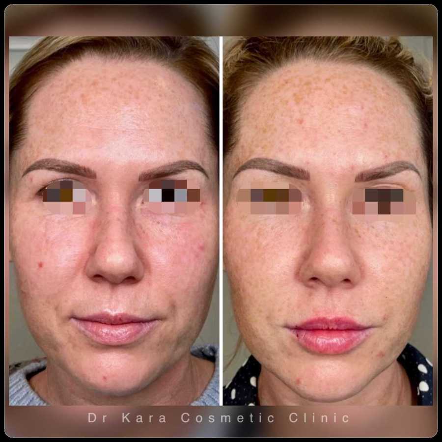 Dr Kara Cosmetic Clinic 16 Skincare, dermal filler, lip filler and PRP facial results by Dr Kara Cosmetic Clinic, Norwich, Norfolk