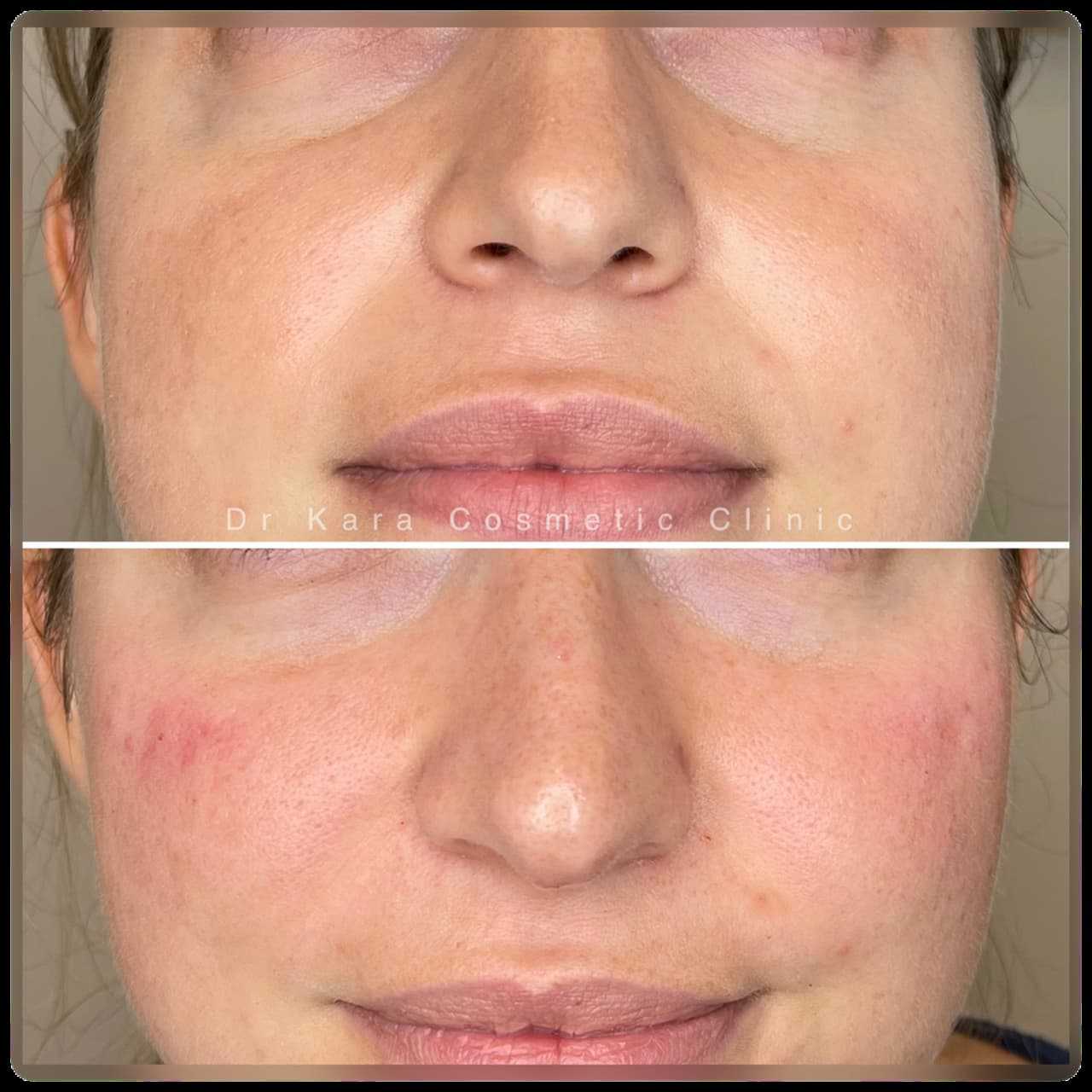 Dr Kara Cosmetic Clinic 12 Tear trough dermal filler result by Dr Kara Cosmetic Clinic , Norwich , Norfolk