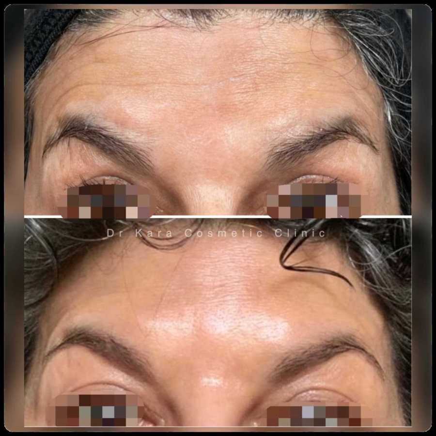 Dr Kara Cosmetic Clinic 9 Botox forehead result by Dr Kara Cosmetic Clinic , Norwich , Norfolk