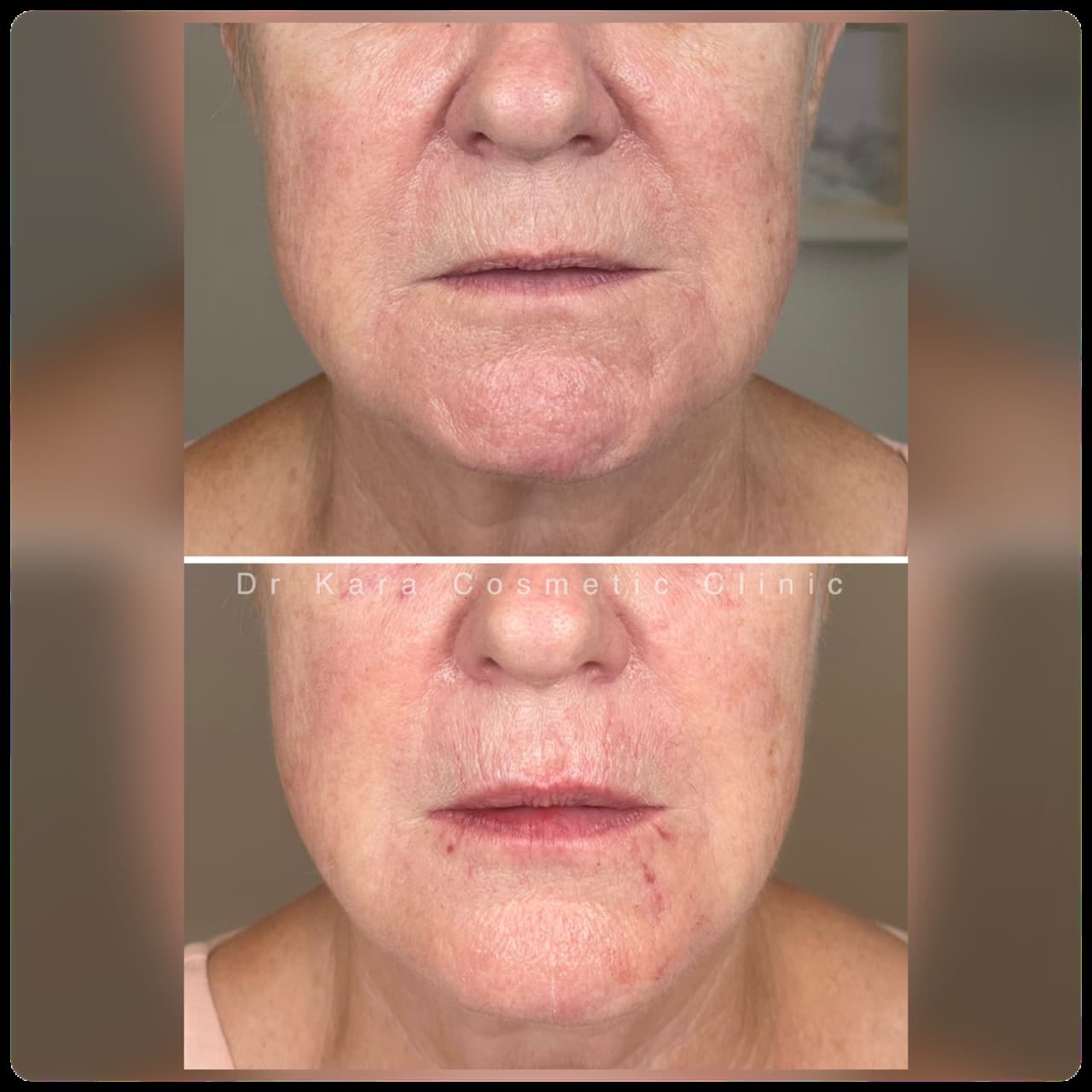 Full face - smokers lines, lips, cheeks, nasolabial lines, chin, prejowl dermal filler result