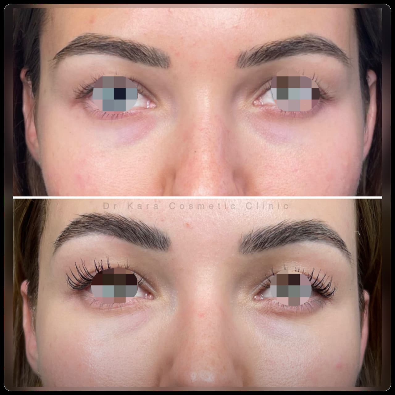 Nucleofill undereye and skincare result by Dr Kara Cosmetic Clinic , Norwich , Norfolk