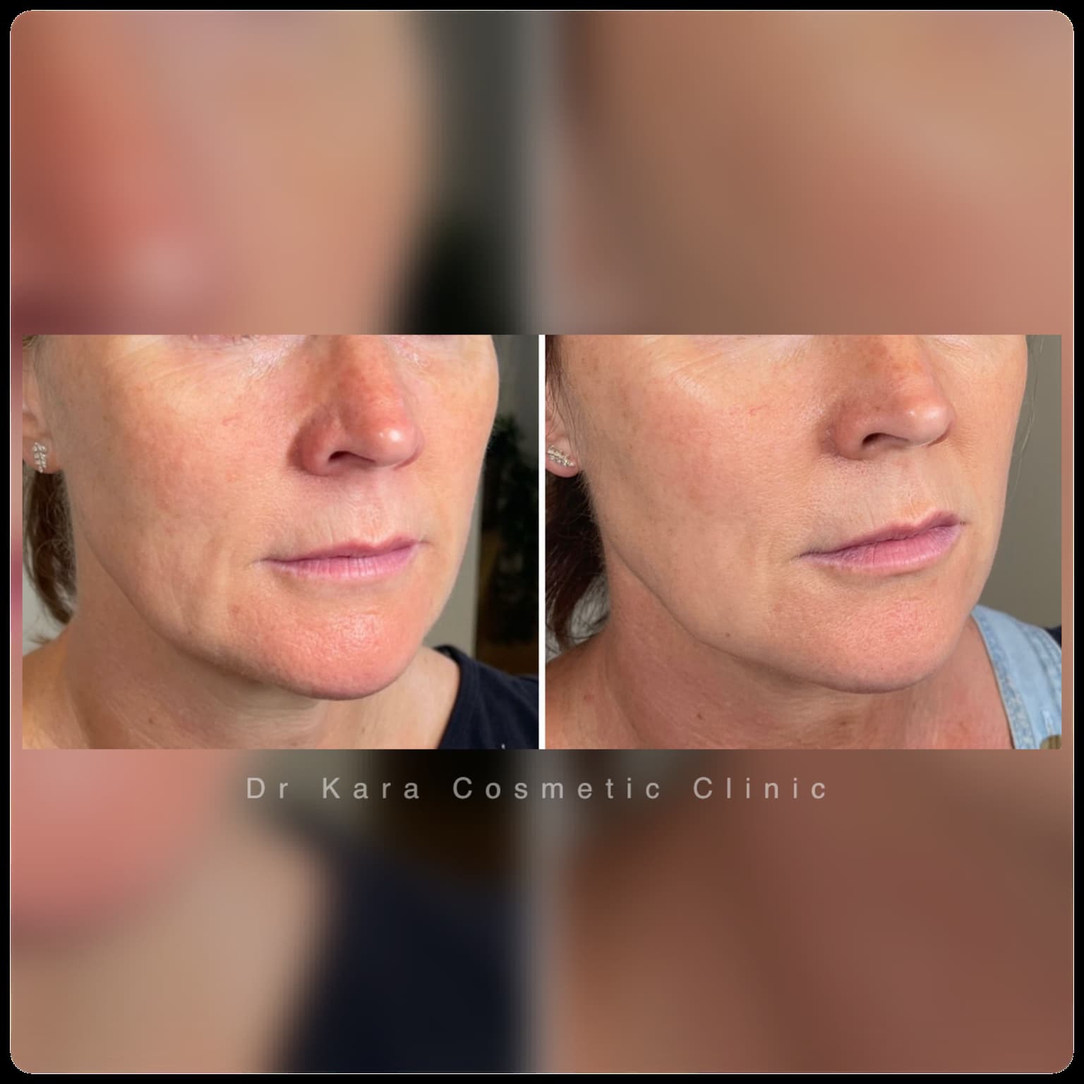 Sunekos result by Dr Kara Cosmetic Clinic, Norwich, Norfolk