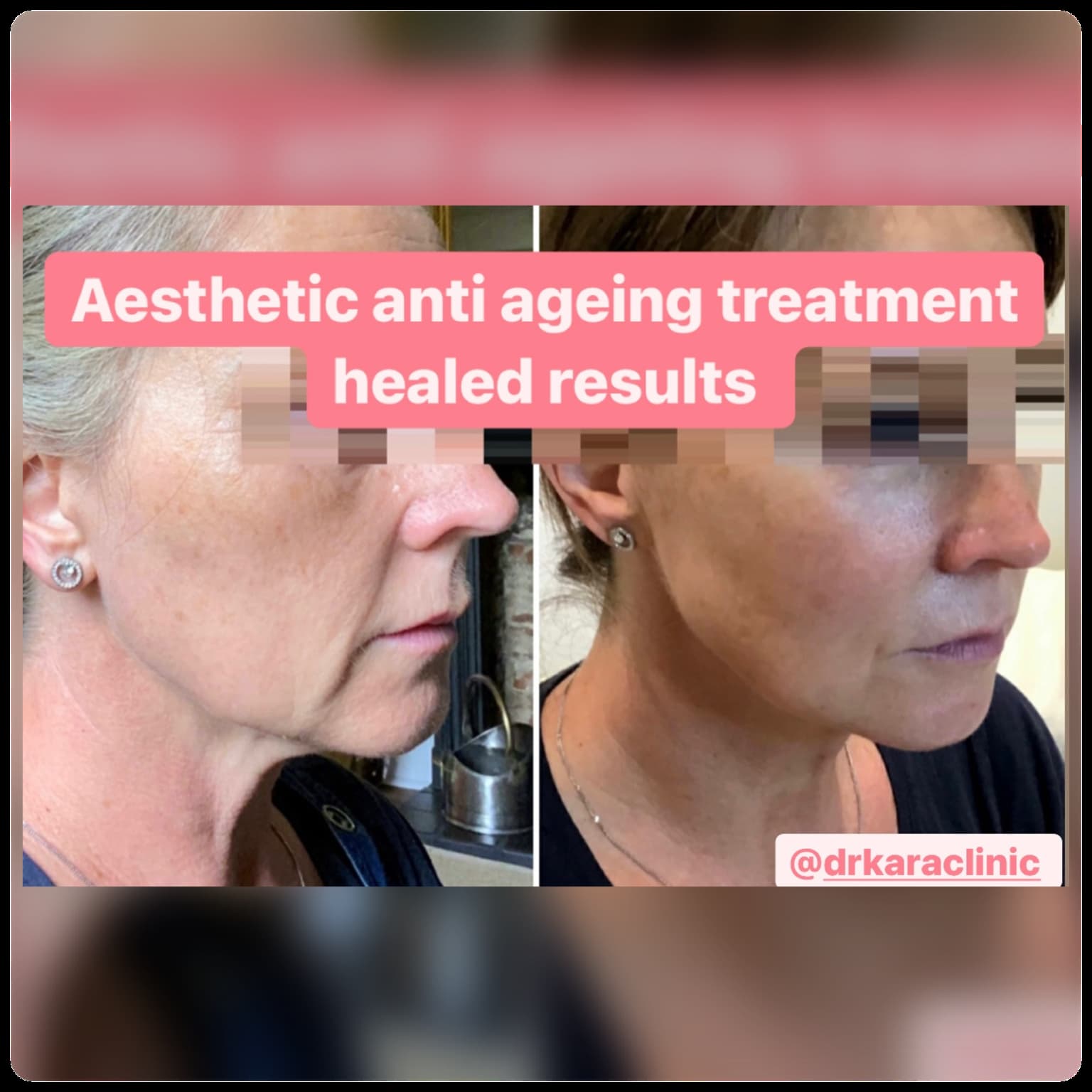 Sunekos and dermal cheek filler result by Dr Kara Cosmetic Clinic , Norwich , Norfolk