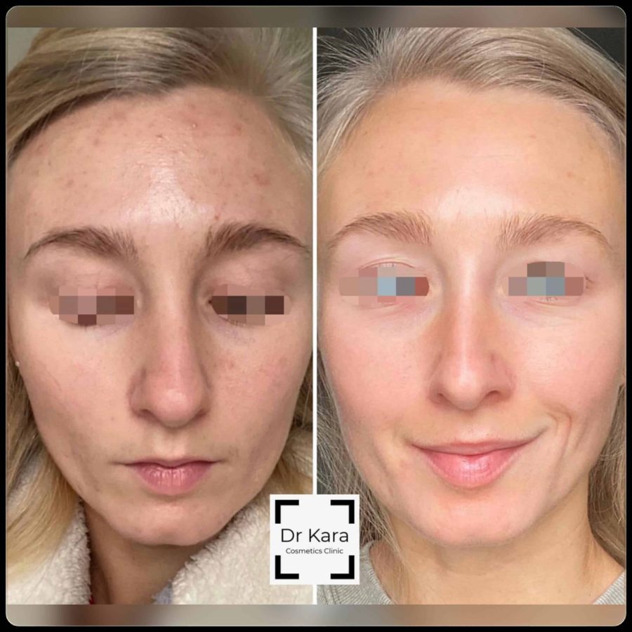 Dr Kara Cosmetic Clinic 10 Skincare result by Dr Kara Cosmetic Clinic , Norwich , Norfolk
