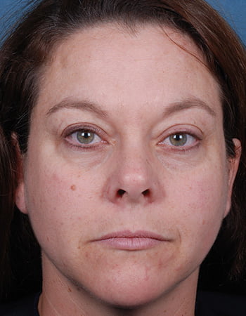 BeforeAfter BluePeels 1 After