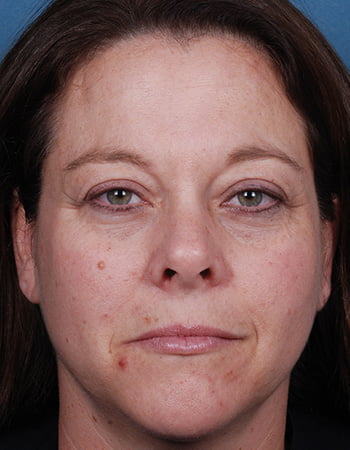 BeforeAfter BluePeels 1 Before 0