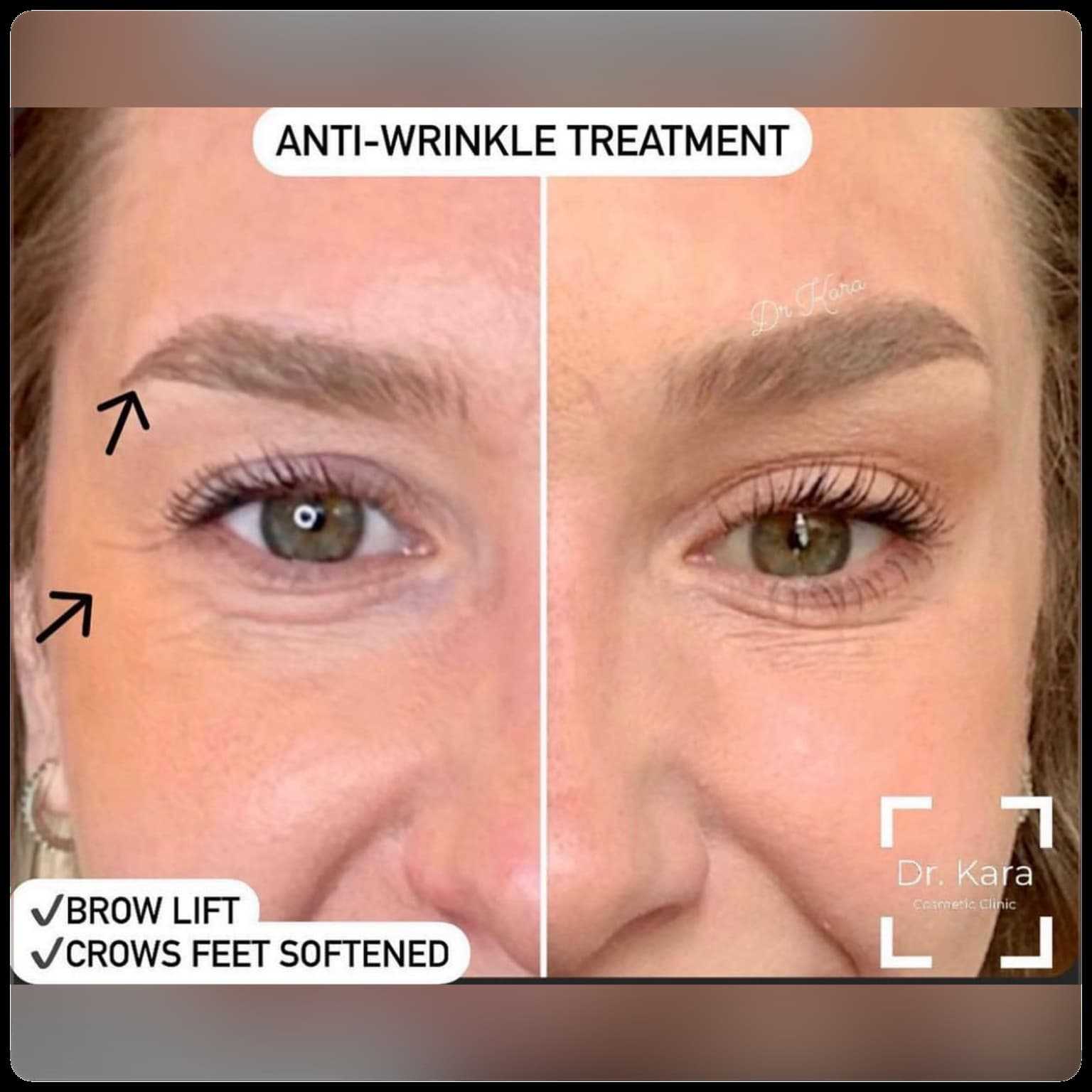 Botox eyebrow lift by Dr Kara Cosmetic Clinic , Norwich , Norfolk