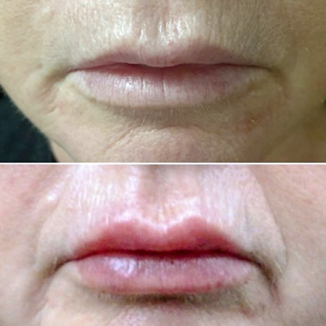Lip Filler Dr Kara Cosmetic Clinic Norwich Aesthetics