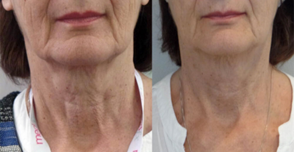 Neck Profhilo e1604327494697