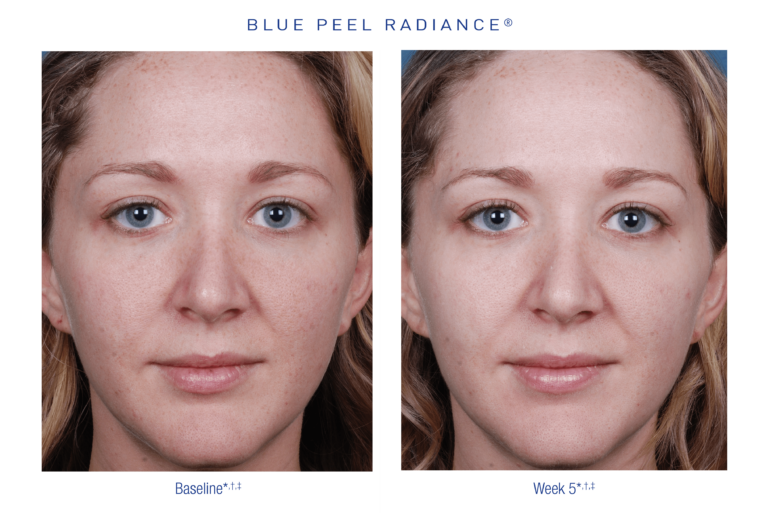 Treatments 21 Before and after photos of an Obagi Blue Peel treatment