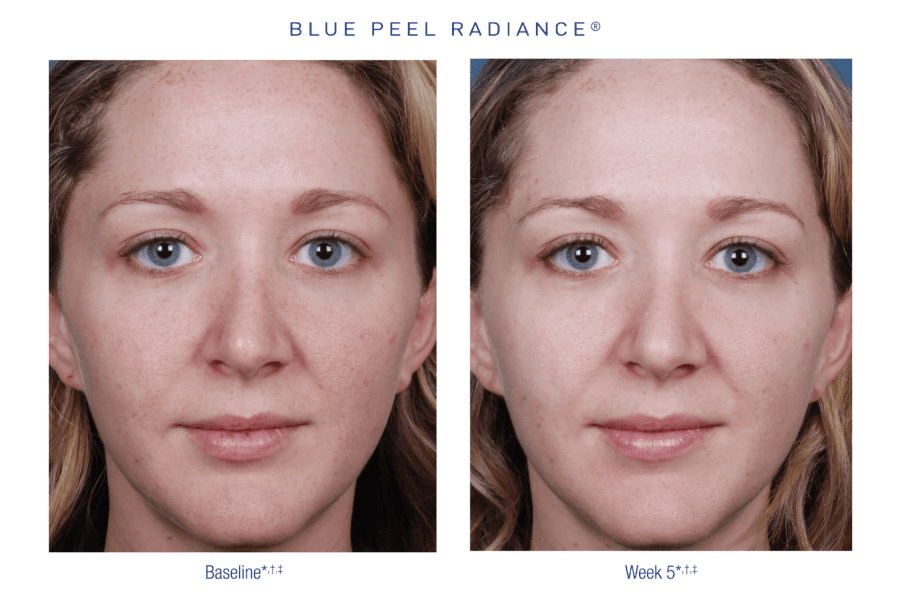 Before and after 3 Obagi peels