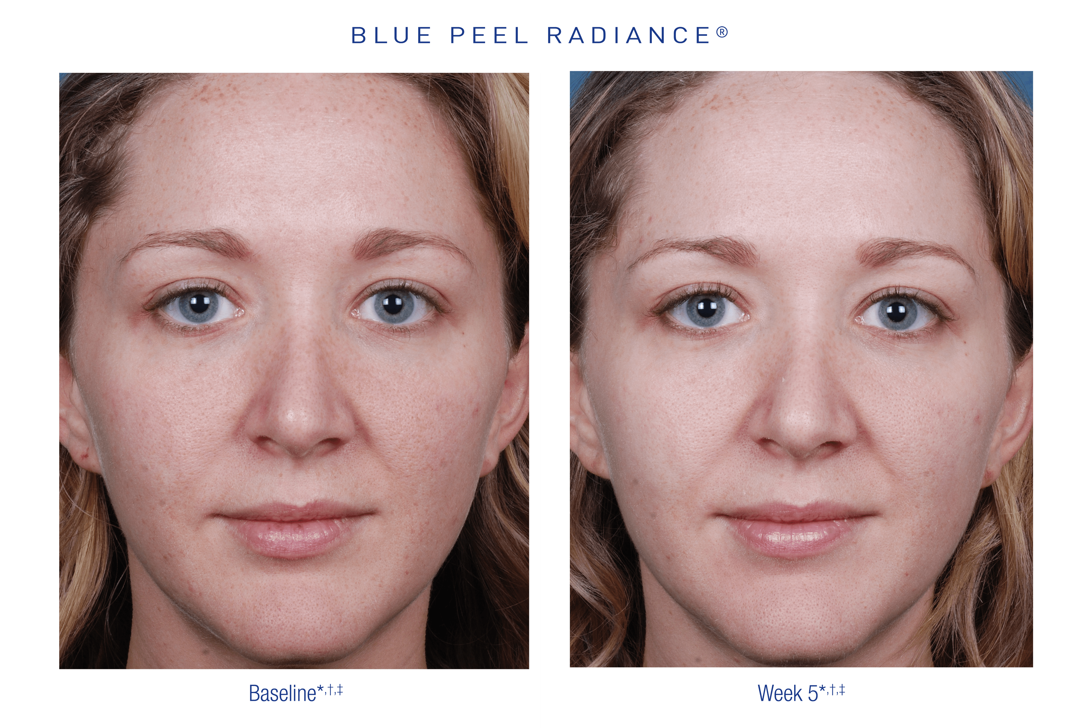 OBAGI blue peel US BPR Before After 2 small e1592226350429
