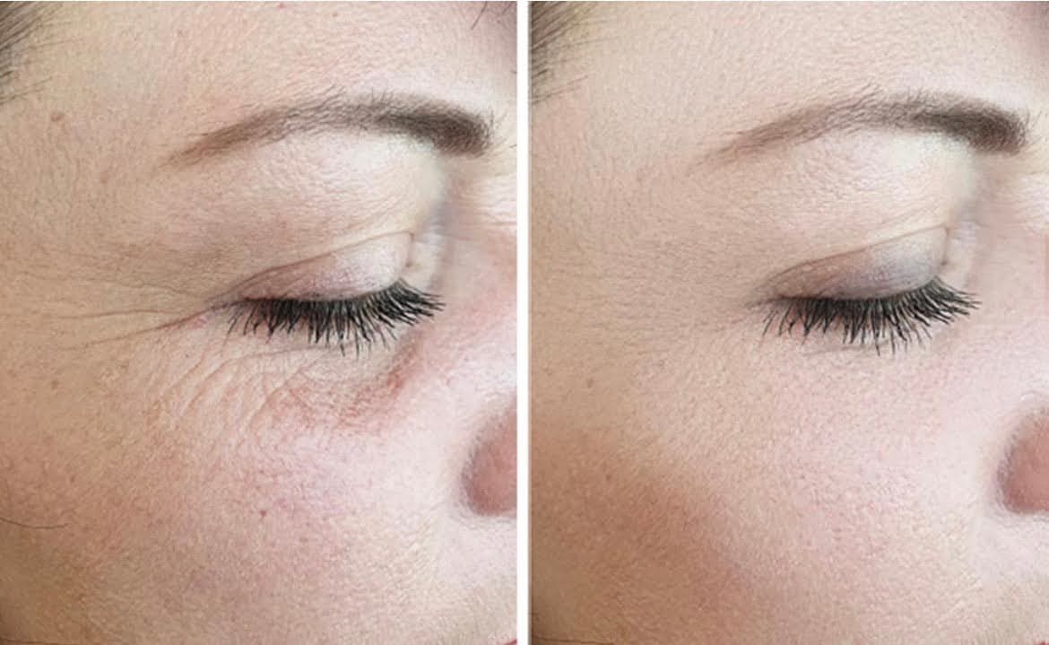 Rejuran Before and After Undereye Result