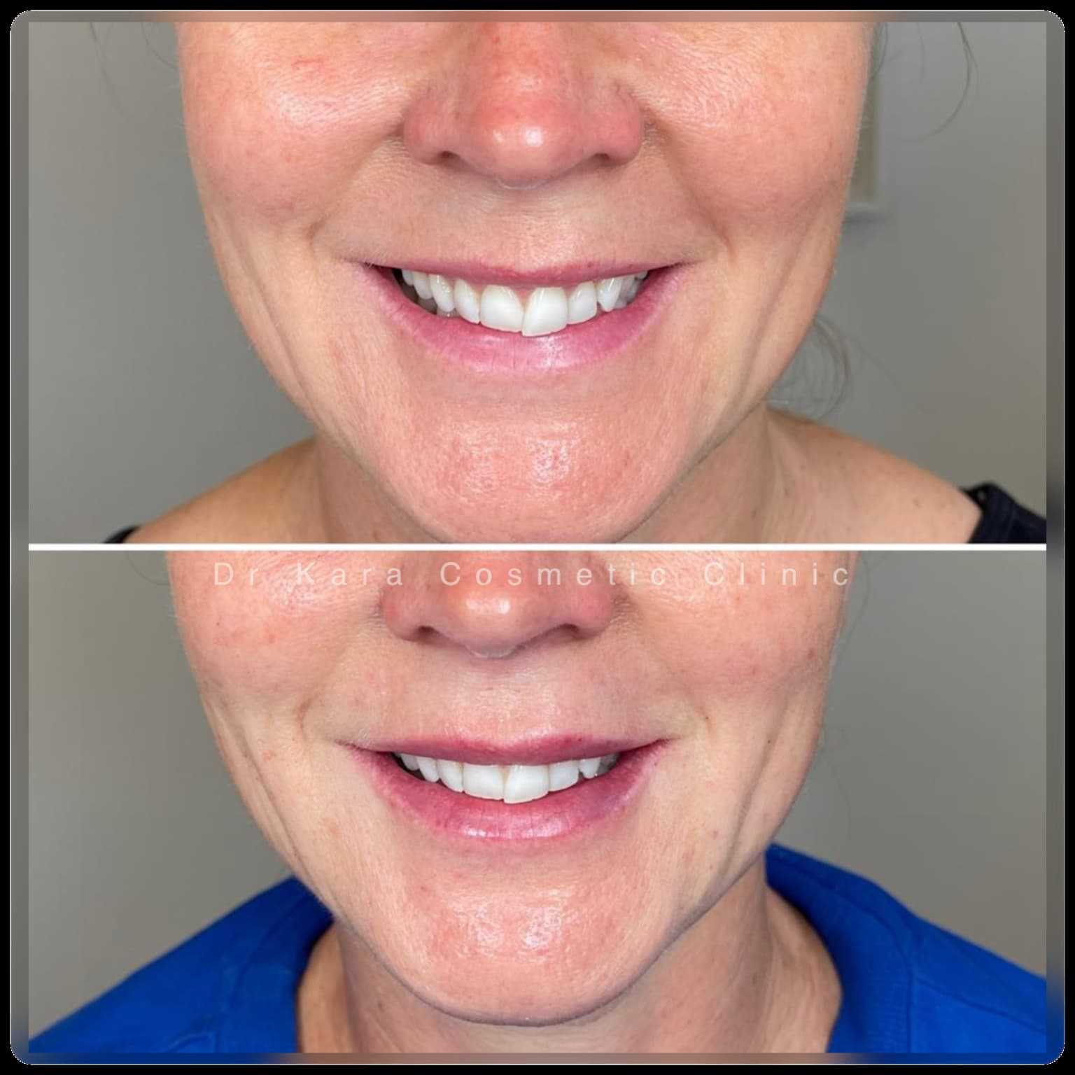 Lip filler results by Dr Kara Cosmetic Clinic in Norwich Norfolk