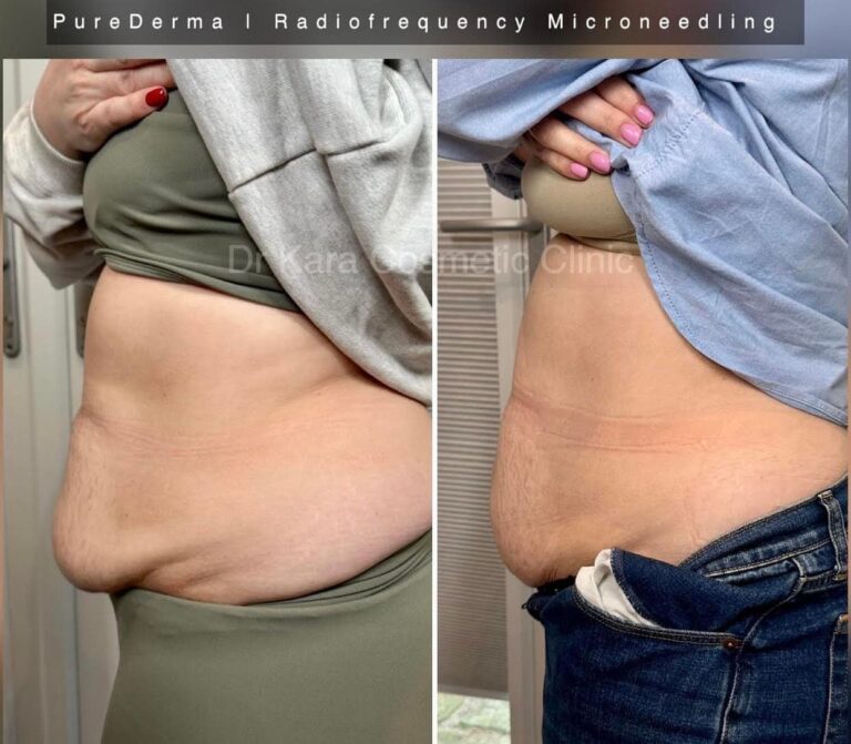 Radiofrequency microneedling body abdomen result in Norwich,Norfolk, UK by PureDerma
