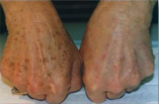 Treatments 22 Hands with age spots before and after Cryopen treatment