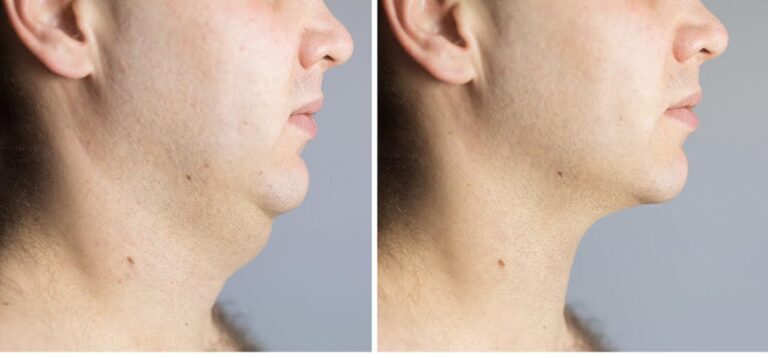 Treatments 4 Before and after photo of an Aqualyx fat dissolving result on the chin