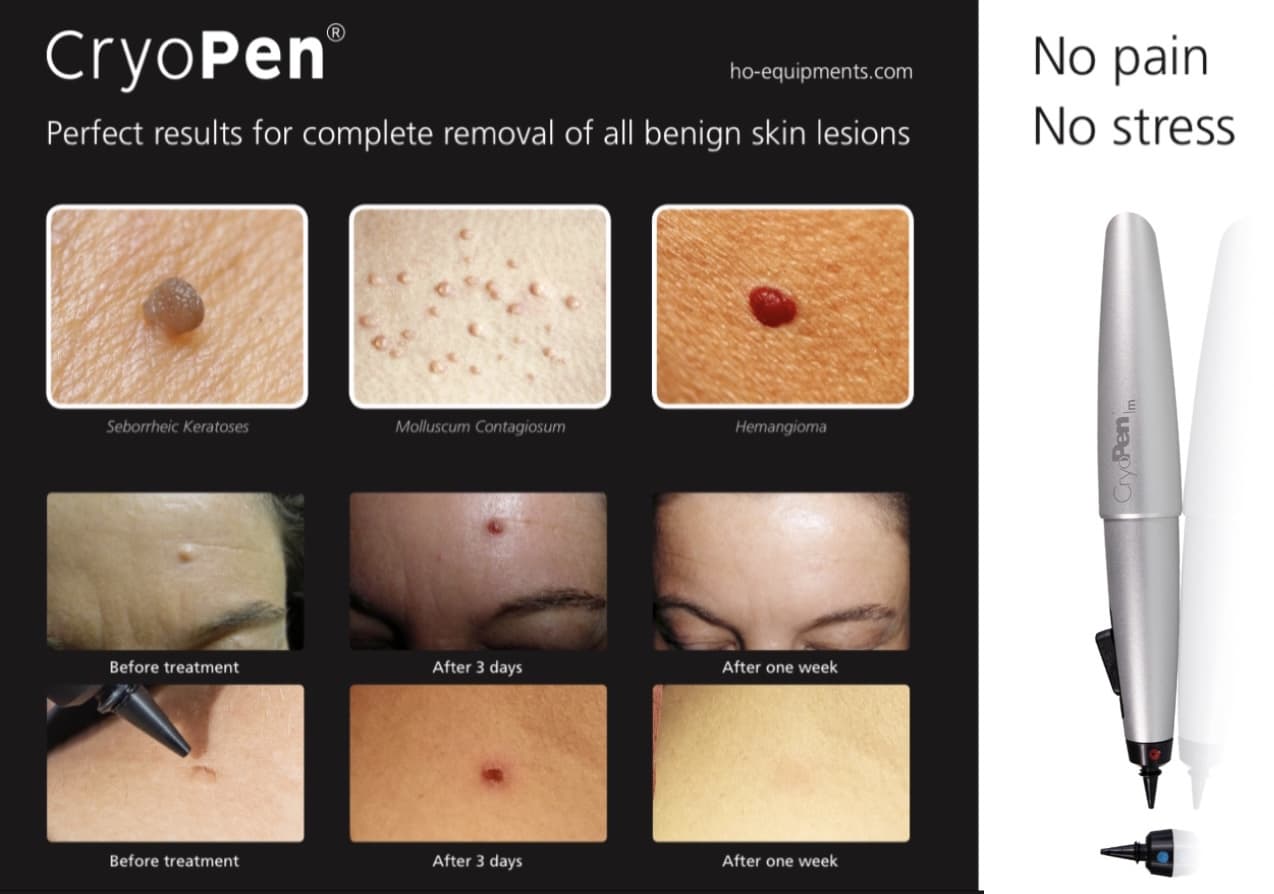 Cryopen - Benign skin lesions being treated