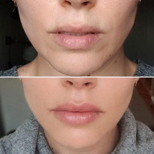 Dermal filler before and after results by Dr Kara Cosmetic Clinic , Norwich, UK