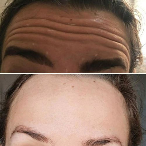 Before and after anti-wrinkle treatment for forehead lines.