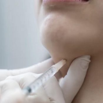 Fat dissolving chin injection
