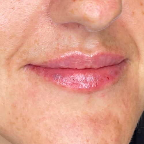 Lip filler result by Dr Kara Cosmetic Clinic in Norwich, Norfolk, UK Lip filler result by Dr Kara Cosmetic Clinic in Norwich, Norfolk, UK