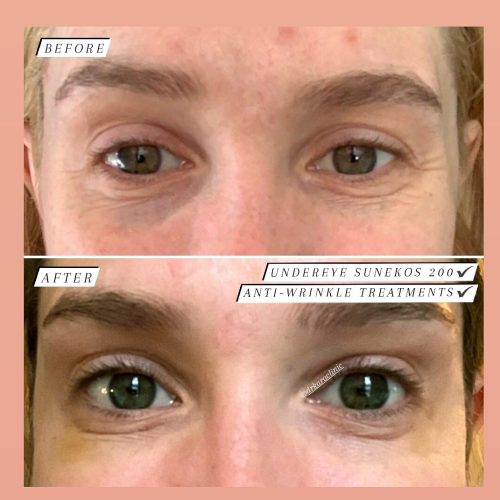 Botox / anti-wrinkle treatment Chemical brow lift by Dr Kara Cosmetic Clinic + Skin booster Sunekos 200 treatment Botox / anti-wrinkle treatment Chemical brow lift by Dr Kara Cosmetic Clinic + Skin booster Sunekos 200 treatment