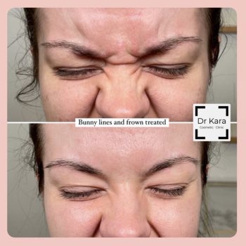 Frown and bunny line botox Frown and bunny line botox anti-wrinkleby Dr Kara Cosmetic Clinic , Norwich , UK