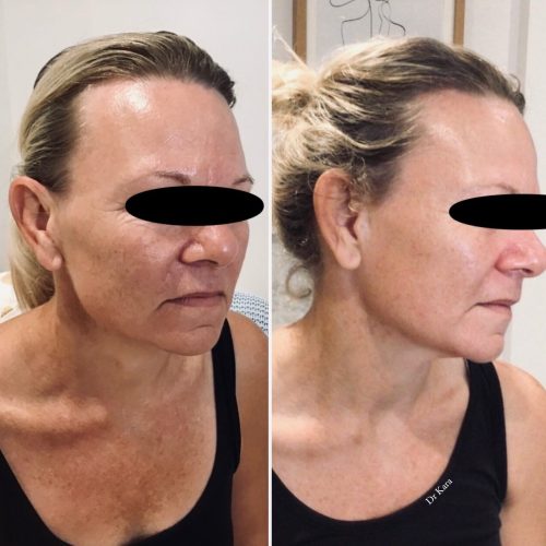 chemical peel chemical peel