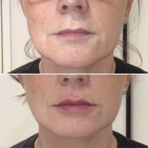 Before and after 0.5 mls lip filler